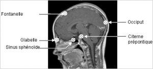 Visualisation de 5 des onze points d’estimation de la dose de rayonnements ionisants reçue par le cerveau au cours de la radiothérapie. Source Inserm.